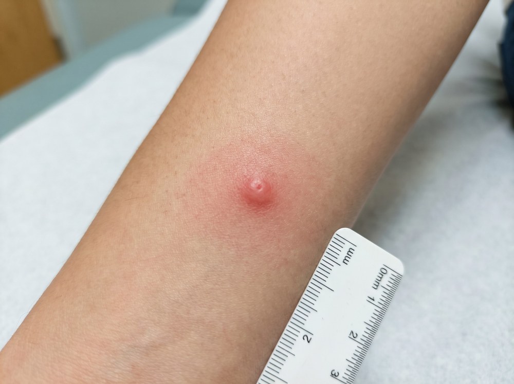 Close-up of a person's forearm showing mild redness and a faint yellow-brown stain from kudzu bug contact with no puncture mark